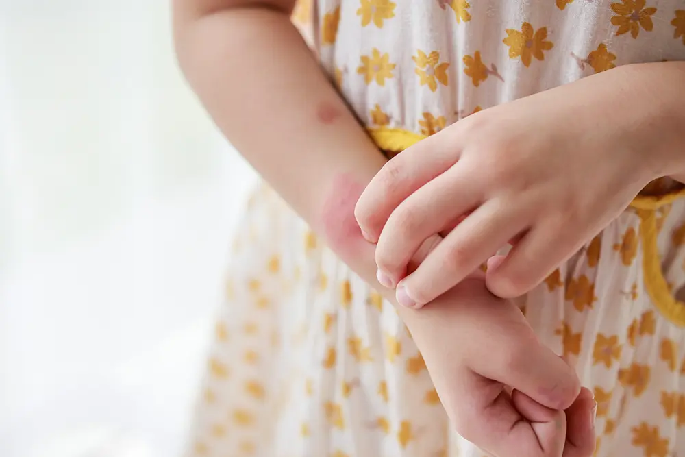 What is Childhood Eczema